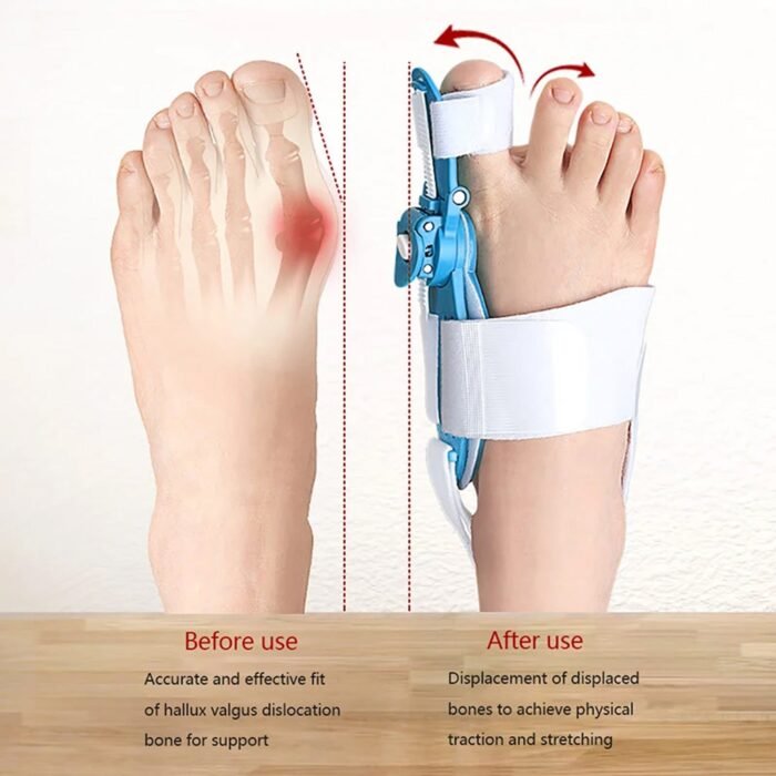 Bunion Support Splint. Valgus And Bunion Valgus,  Corrector,  Hallux Valgus Corrector,  Adjustable Bunion Valgus Protective Cover For Men And Women - Image 5